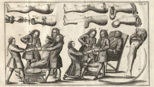 amputation guide thumb